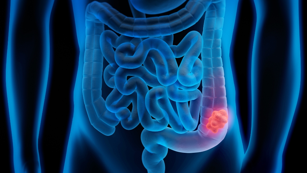 3d illustration of colon cancer with a tumor highlighted